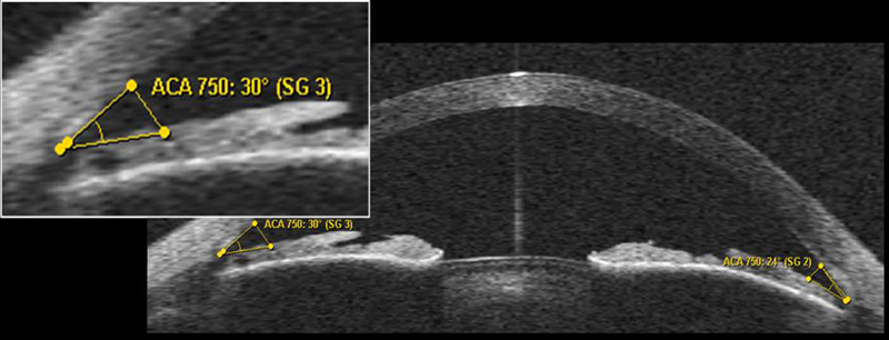 Digital gonioscopy