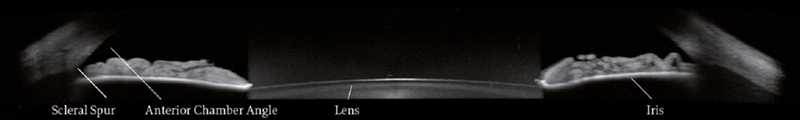 OCT of both iridocorneal angles