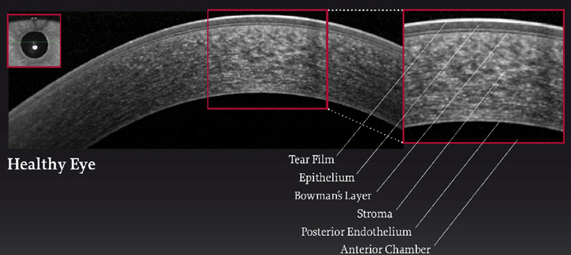 OCT of a normal cornea