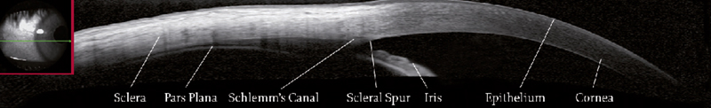 OCT image of the sclera with iridocorneal angle