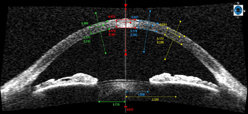 Corneal pachymetry