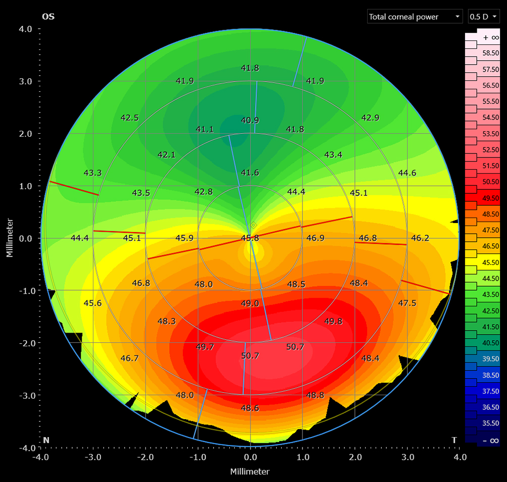 A map for analyzing the corneal structure