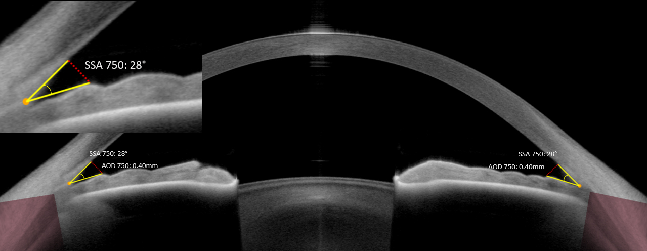 Digital gonioscopy
