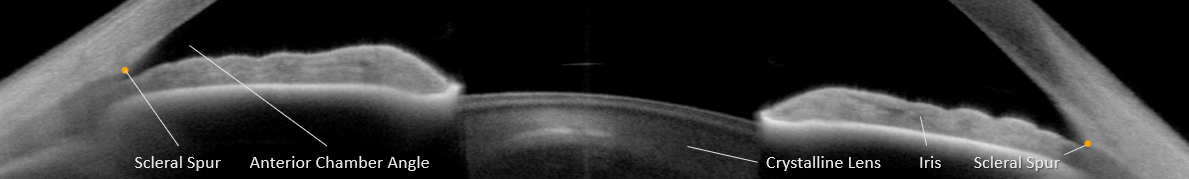 OCT of both iridocorneal angles