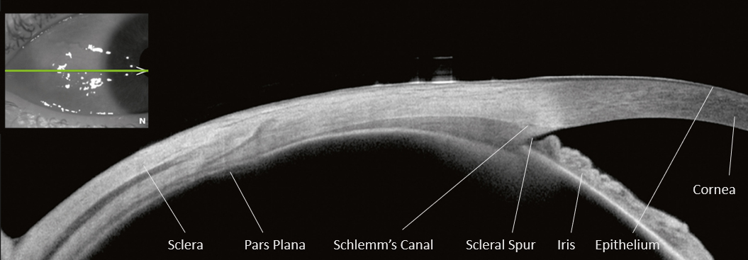 OCT image of the sclera with iridocorneal angle