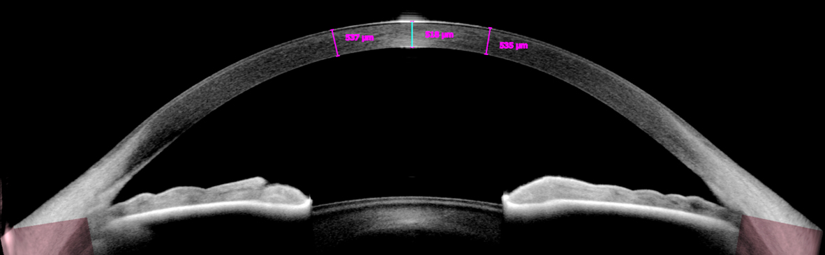 Corneal pachymetry